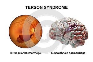 A 3D illustration of Terson syndrome, revealing intraocular hemorrhage observed during ophthalmoscopy and intracranial