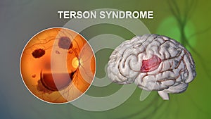 A 3D illustration of Terson syndrome, revealing intraocular hemorrhage observed during ophthalmoscopy and intracranial