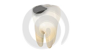 3D illustration of a tooth decay