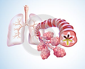 3D illustration of trachea and air sacs in human lungs highlighting bronchitis and filled with phlegm