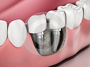 3D illustration of two dental implants on the lower jaw