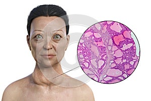A 3D illustration of a woman with Graves' disease alongside a micrograph image of thyroid tissue affected by