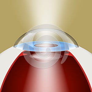 3D Intraocular Lens Implantation Model With Light