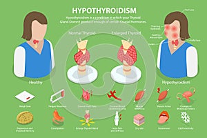 3D Isometric Flat Vector Conceptual Illustration of Hypothyroidism