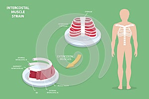 3D Isometric Flat Vector Conceptual Illustration of Intercostal Muscle Strain