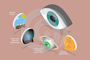 3D Isometric Flat Vector Conceptual Illustration of Retinal Degenerative Vision