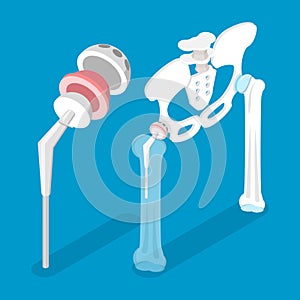 3D Isometric Flat Vector Conceptual Illustration of Total Hip Replacement