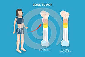 3D Isometric Flat Vector Illustration of Bone Tumor