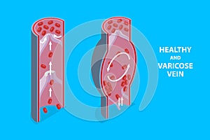 3D Isometric Flat Vector Illustration of Healthy And Varicose Vein