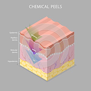 3D Isometric Flat Vector Illustration of Skin Chemical Peel