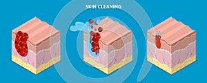 3D Isometric Flat Vector Illustration of Skin Cleaning