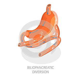 3D Isometric Flat Vector Illustration of Types Of Bariatric Surgery. Item 1