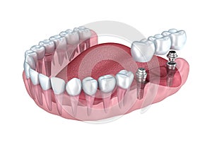 3d lower teeth and dental implant transparent render