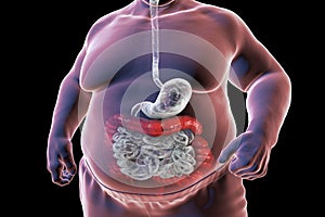 A 3D medical illustration depicting the upper half part of a senior obese male body with a highlighted digestive system