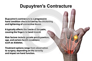 A 3D medical illustration displaying a patient's hand with Dupuytren's contracture, emphasizing the affected