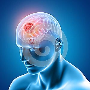 3D medical image showing male figure with brain tumour