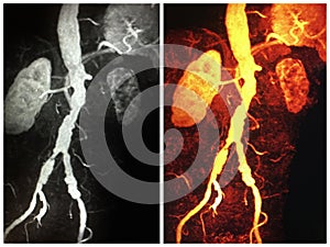 3d mra atrophic kidney ectatic iliac arteries thrombus