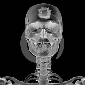 3D Radiograph with head injury