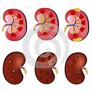 3D Realistic anatomy vector set kidney, normal kidney, kidney infection, sick kidney. Anatomy human. Medicine concept