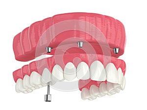 3d render of all on 4 dental implants treatment