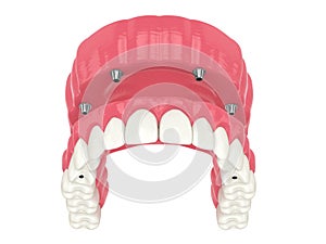 3d render of all on 4 dental implants treatment