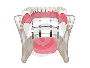 3d render of bar retained removable overdenture installation supported by four implants