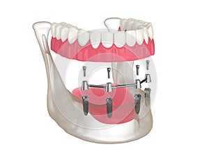 3d render of bar retained removable overdenture installation supported by four implants