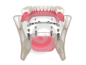 3d render of bar retained removable overdenture installation supported by implants