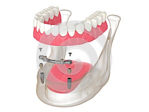 3d render of bar retained removable overdenture installation supported by two implants