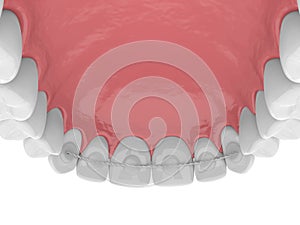 3d render of dental bonded retainer on upper jaw