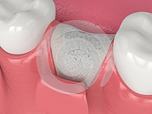 3D render of dental bone grafting with bone biomaterial and membrane