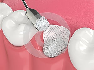 3D render of dental bone grafting with bone biomaterial and membrane