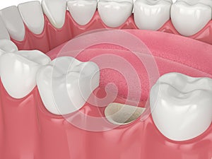 3D render of dental bone grafting with bone biomaterial and membrane