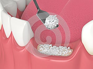 3D render of dental bone grafting with dental bone biomaterial