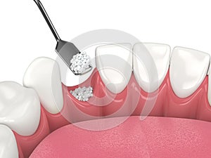 3D render of dental bone grafting with dental bone biomaterial