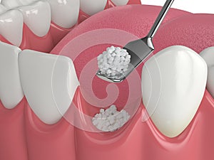 3D render of dental bone grafting with dental bone biomaterial