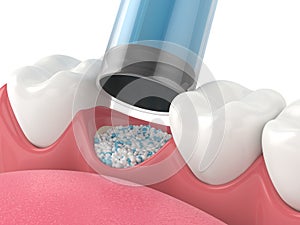 3D render of dental bone grafting with dental bone biomaterial application