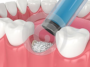 3D render of dental bone grafting with dental bone biomaterial application