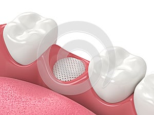 3D render of dental bone grafting with membrane