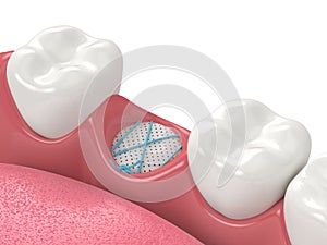 3D render of dental bone grafting with membrane and sutures