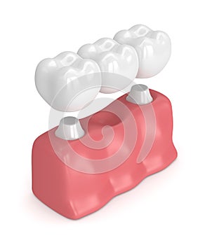 3d render of dental bridge with dental crowns