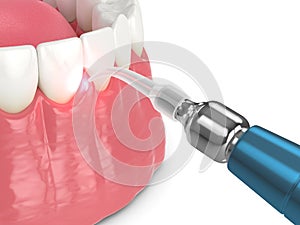 3d render of dental diode laser used to treat gums