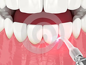 3d render of dental diode laser used to treat gums