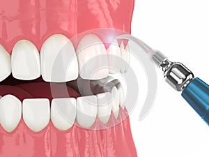 3d render of dental diode laser used to treat gums