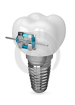 3d render of dental implant and brace