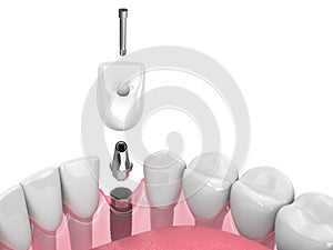 3d render of dental implant in jaw over white