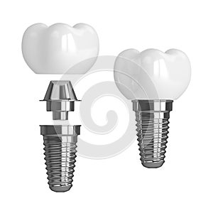 3d render of dental implants