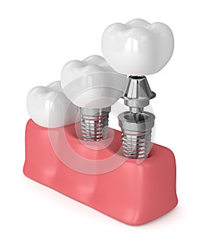 3d render of dental implants in gums