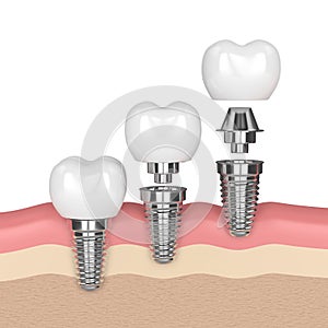 3d render of dental implants in gums