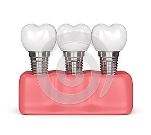 3d render of dental implants in gums